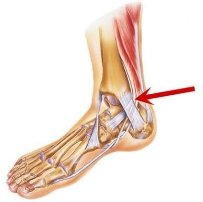 NHỮNG BÀI TẬP HIỆU QUẢ NHẤT GIÚP RUNNER PHỤC HỒI VIÊM GÂN CHÀY SAU
