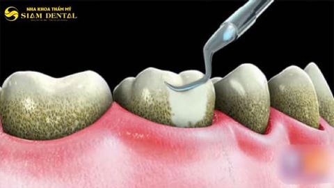 Làm gì để răng miệng luôn khỏe mạnh ?