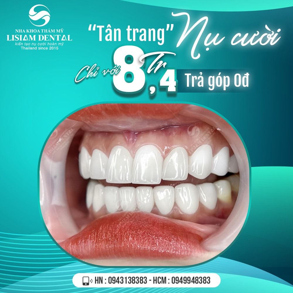 Tân trang nụ cười hoàn mỹ - Ưu đãi chỉ 8,4 triệu