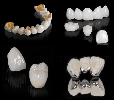 Các Loại Răng Sứ Phổ Biến Và Cách Chọn Loại Phù Hợp