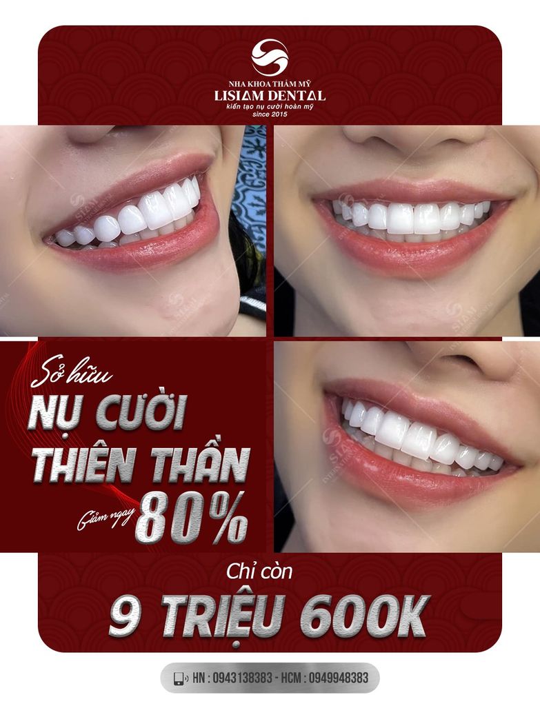 Sở hữu nụ cười thiên thần - Giảm ngay 80% - Chỉ 9 triệu 600K
