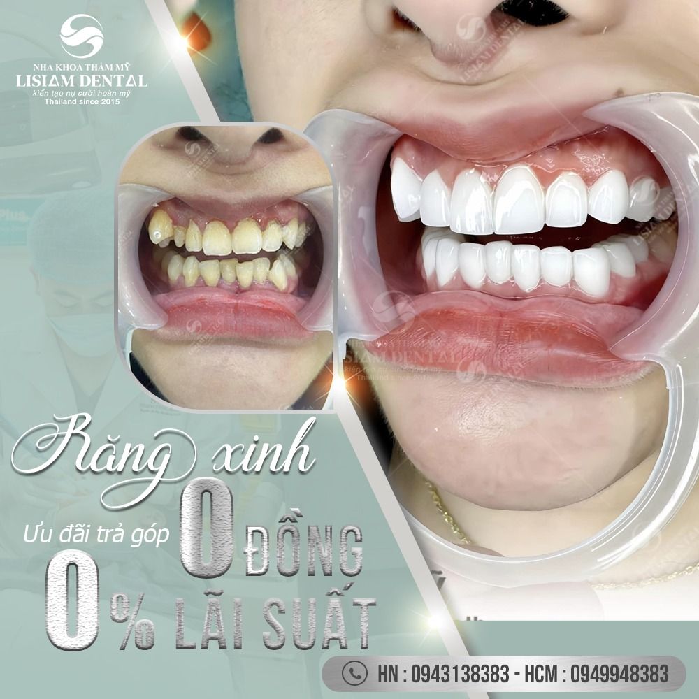 RĂNG SÁNG CƯỜI XINH - RINH ƯU ĐÃI KHỦNG