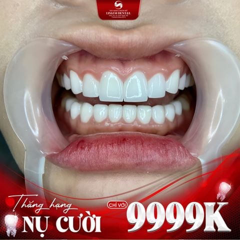 Cách Đánh Giá Răng Sứ Làm Có Đúng Kỹ Thuật Không