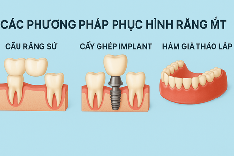 Phục Hình Răng Mất – Những Điều Cần Biết Để Lựa Chọn Đúng