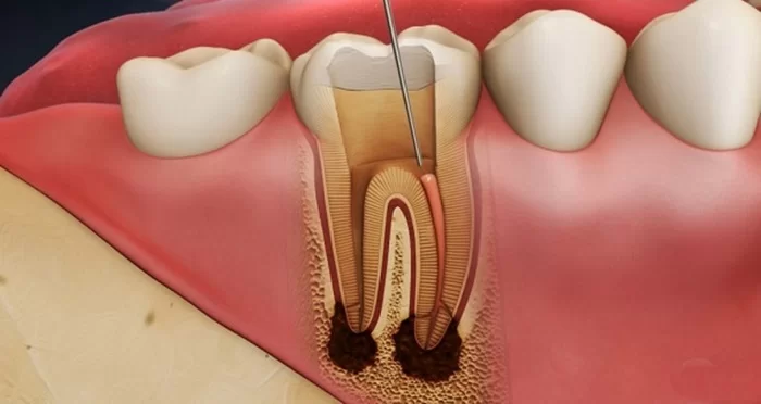 Sự Khác Biệt Giữa Điều Trị Tủy Răng Sữa Và Tủy Răng Vĩnh Viễn