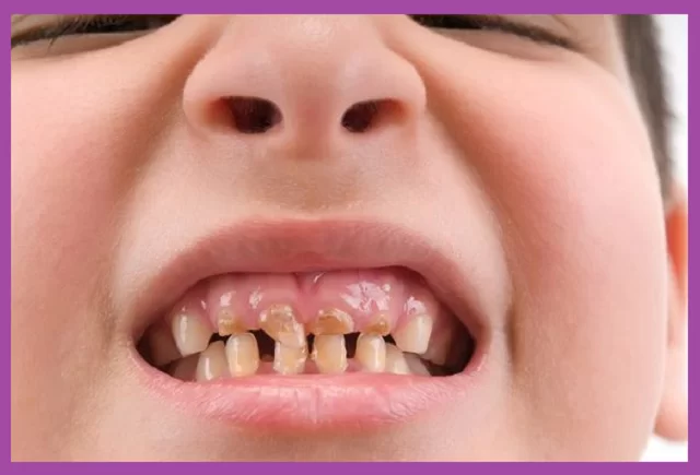 Viêm Tủy Răng Sữa Có Thể Gây Sốt Ở Trẻ – Hiểu Biết Và Xử Lý Kịp Thời