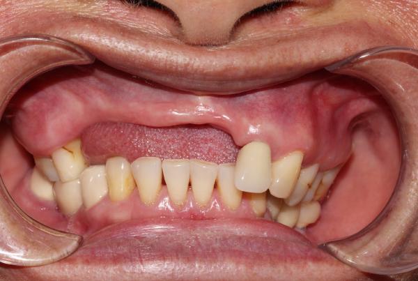 Tại Sao Phục Hình Răng Mất Sớm Là Quan Trọng? Đừng Để Quá Muộn!