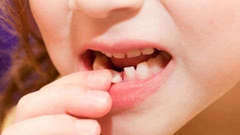 Khi Nào Nên Nhổ Răng Sữa Để Không Ảnh Hưởng Đến Răng Vĩnh Viễn?