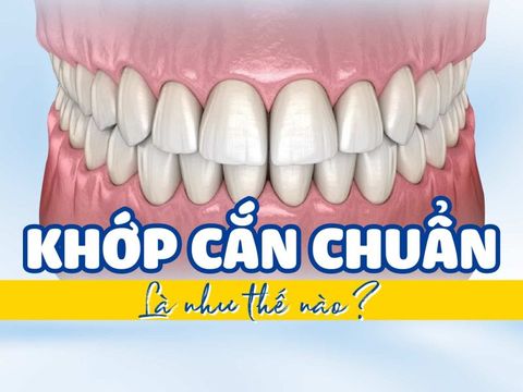 Khớp Cắn Chuẩn – Bí Quyết Cho Hàm Răng Khỏe Mạnh Và Nụ Cười Hoàn Hảo