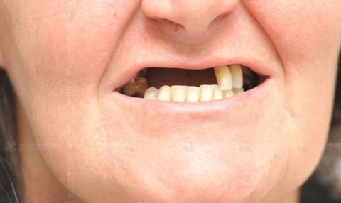 Răng Mất Lâu Ngày Có Phục Hình Được Không? Giải Đáp Từ Siam Dental