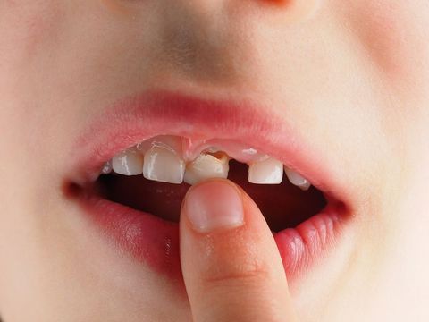 Con Bạn Bị Vỡ Răng Sữa? Cách Xử Lý Nhanh Chóng Và Hiệu Quả