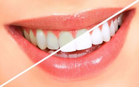 Phục Hình Răng Gãy Bằng Răng Sứ – Giải Pháp Hoàn Hảo Tại Nha Khoa Siam Dental
