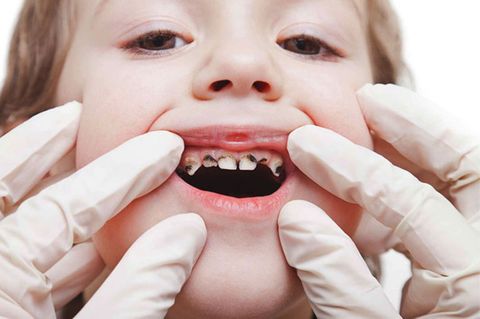 Viêm Tủy Răng Sữa Có Thể Ảnh Hưởng Đến Răng Vĩnh Viễn – Hiểu Biết Và Phòng Ngừa