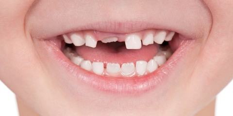 Chăm Sóc Răng Sữa – Nền Tảng Cho Hàm Răng Vĩnh Viễn Khỏe Mạnh