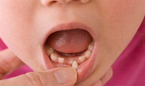 Răng Sữa Lung Lay Sớm – Nguyên Nhân Và Cách Xử Lý Để Bảo Vệ Nụ Cười Bé Yêu