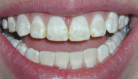 Thiểu Sản Men Răng Là Gì? Tìm Hiểu Cùng Nha Khoa Siam Dental