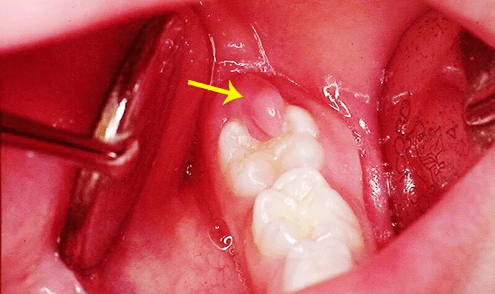 Điều Trị Viêm Lợi Hiệu Quả – Bí Quyết Từ Nha Khoa Siam Dental