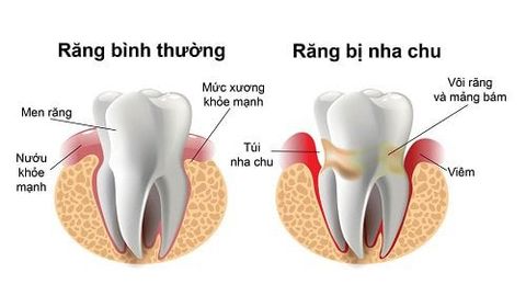 Phân Biệt Viêm Lợi Và Viêm Nha Chu – Giải Đáp Từ Nha Khoa Siam Dental