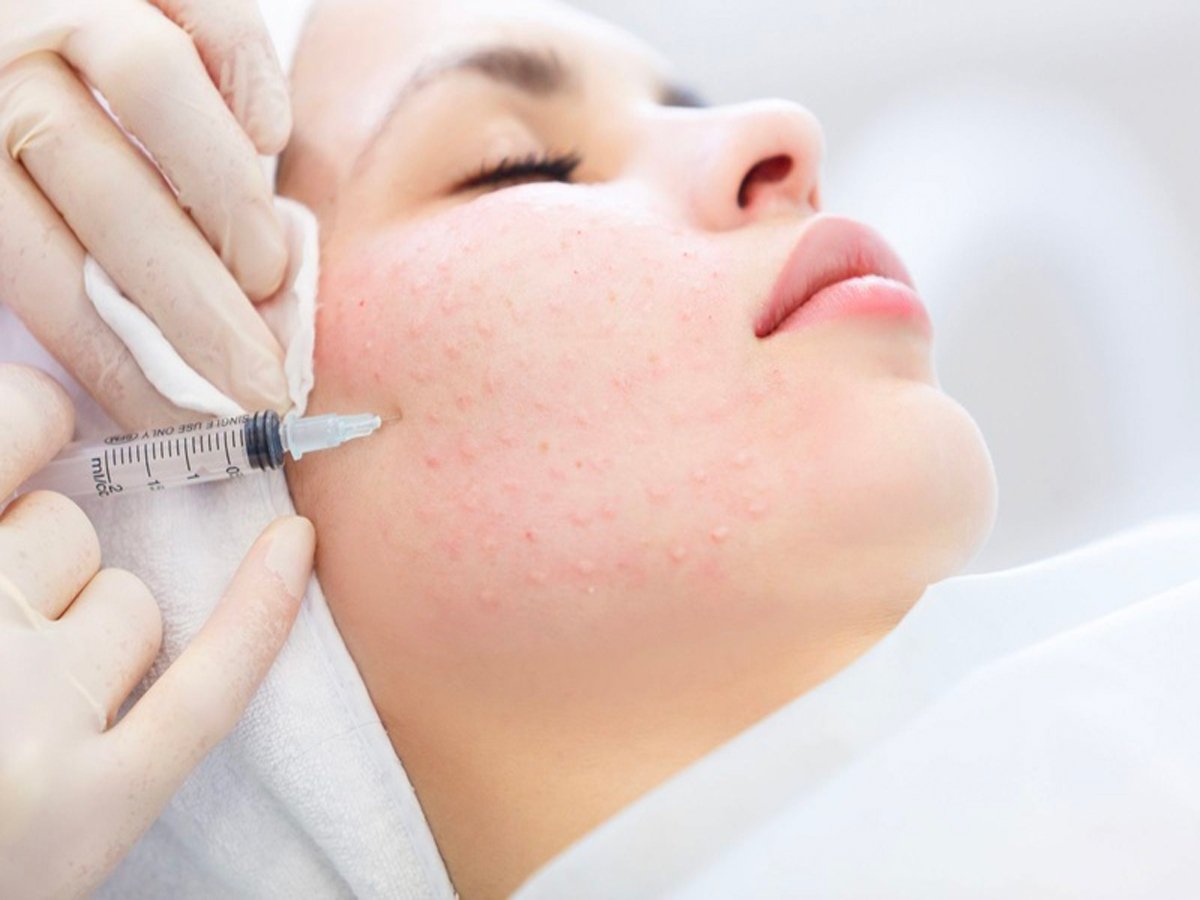 Tìm hiểu các biến chứng tiêm meso thường gặp