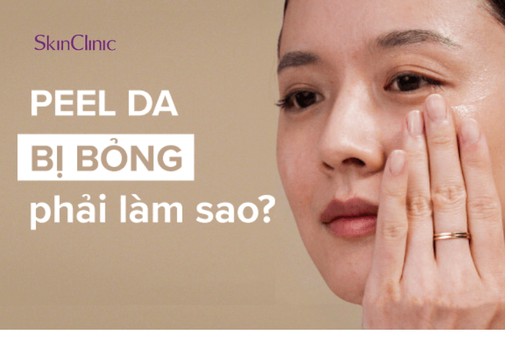 Peel da bị bỏng phải xử lý như thế nào?