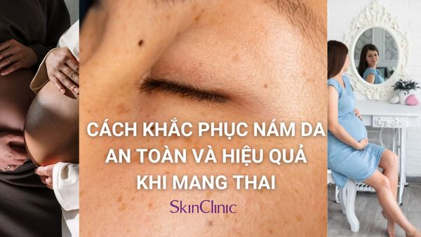 Cách khắc phục Nám da khi mang thai an toàn và hiệu quả