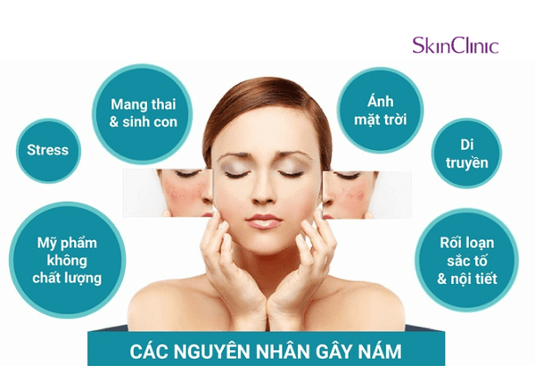 Nguyên nhân nám, tàn nhang xuất hiện