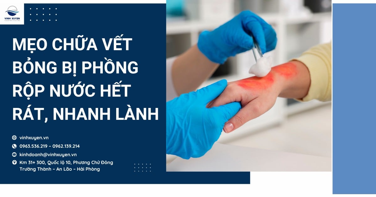 Mẹo chữa vết bỏng bị phồng rộp nước hết rát, nhanh lành
