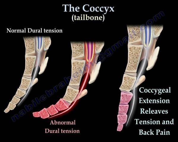 Nguyên nhân đau xương cùng cụt và cách điều trị Tiến sĩ, Bác sĩ Đỗ ...