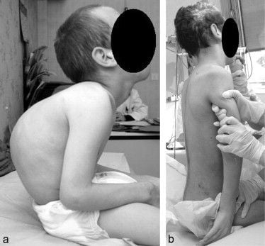 CHỤP X QUANG CỘT SỐNG LƯNG ĐỂ XÁC ĐỊNH MỨC ĐỘ BIẾN DẠNG CỘT SỐNG