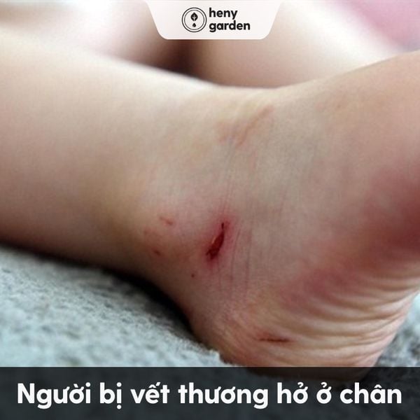 những người nào không nên ngâm chân? người bị các vết thương hở ở chân không nên ngâm chân