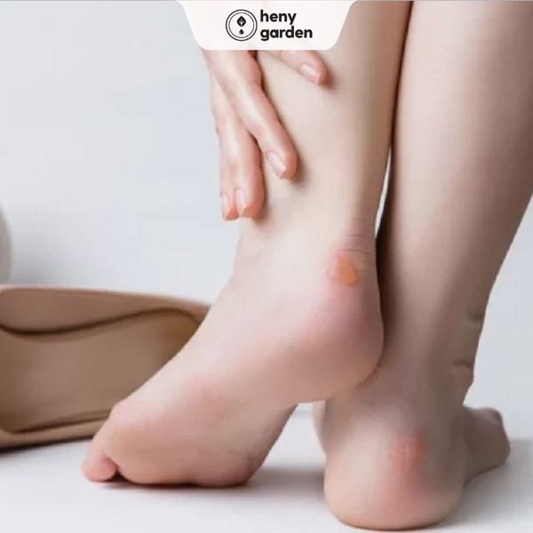 bệnh gì không nên ngâm chân? ngâm chân trị mun nước ở chân