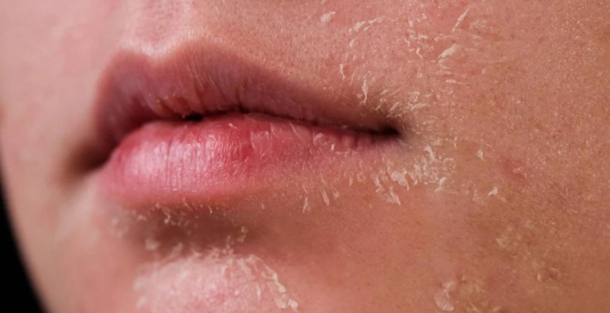 8 cách làm mặt nạ trị mụn cho da khô hiệu quả, nhanh hết mụn