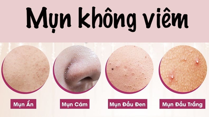 Mụn không viêm: Phân loại, nguyên nhân và cách điều trị