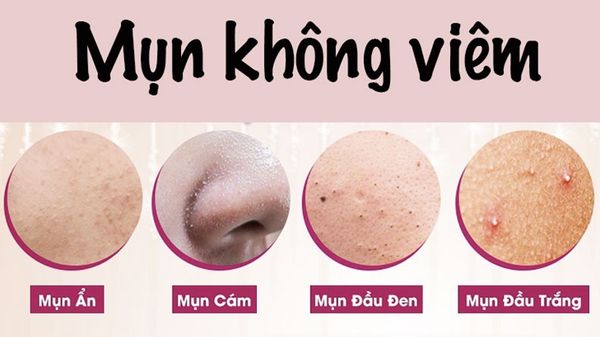 3. Phương pháp điều trị mụn không viêm