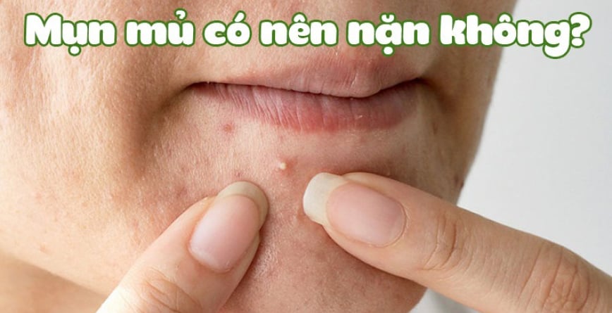 Mụn mủ có nên nặn không? Hướng dẫn nặn mụn mủ chi tiết