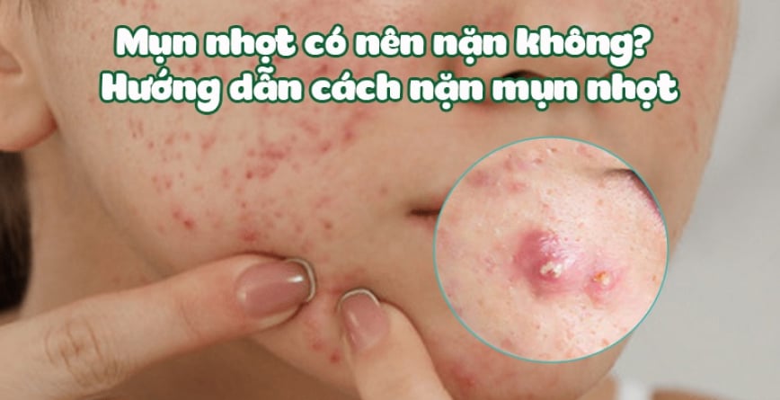 Mụn nhọt có nên nặn không? Hướng dẫn cách nặn mụn nhọt