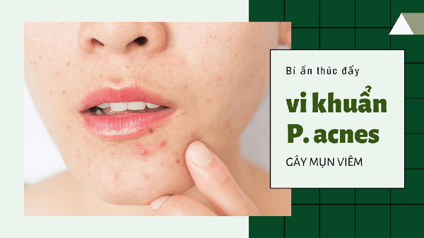 Môi trường nào là lý tưởng để vi khuẩn P.acnes phát triển và gây tổn thương da?
