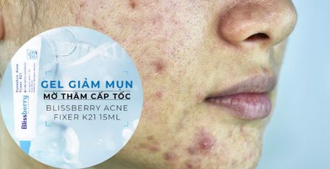 Review gel trị mụn Pureskin Acne Fixer K21 có tốt không?