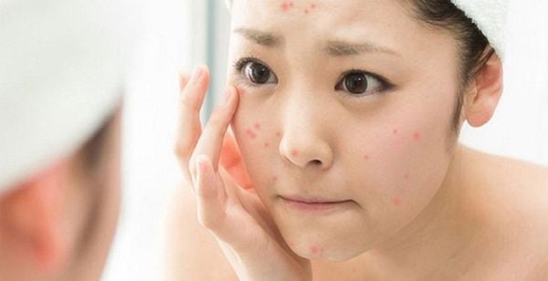 7 sai lầm khi chăm sóc da mụn có thể bạn đang mắc phải