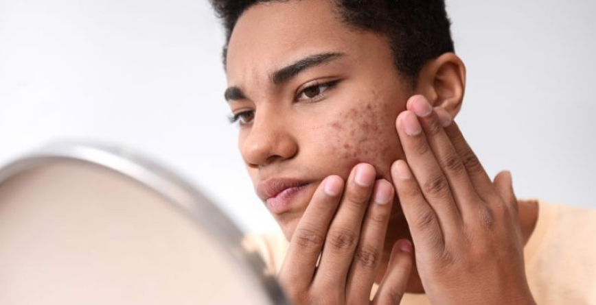 Top 7 sản phẩm trị mụn thâm hiệu quả, không để lại sẹo trên da