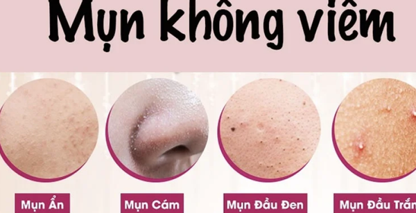 7. Phòng ngừa và chăm sóc viêm