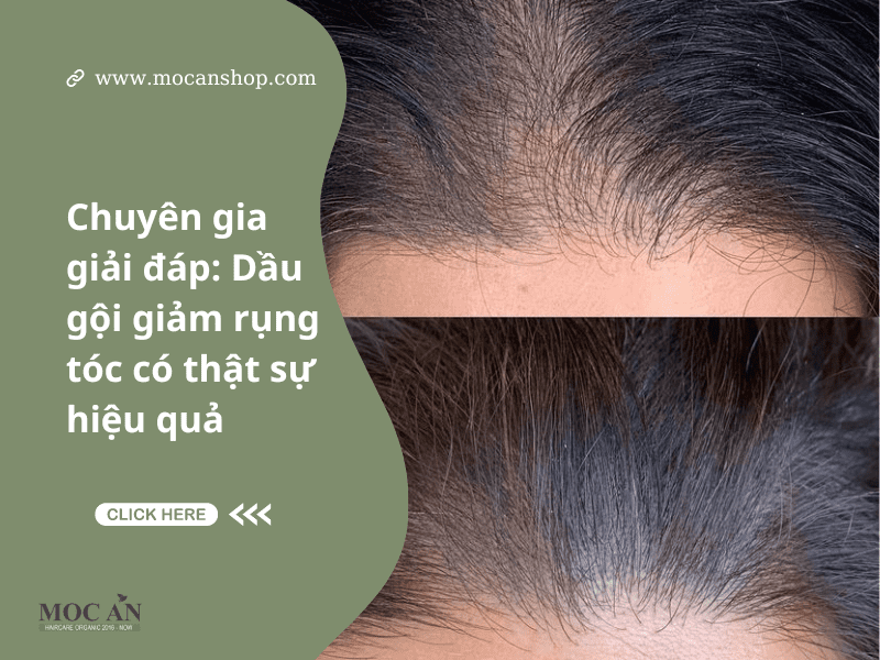 Chuyên Gia Giải Đáp: Dầu Gội Giảm Rụng Tóc Có Thật Sự Hiệu Quả?