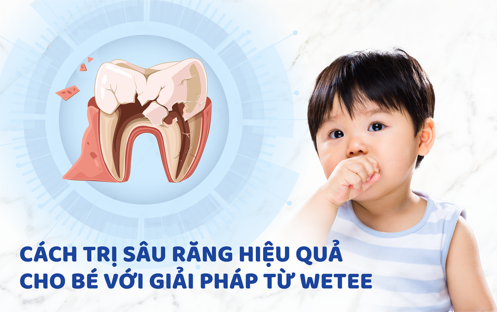 Cách trị sâu răng hiệu quả cho bé với giải pháp từ Wetee