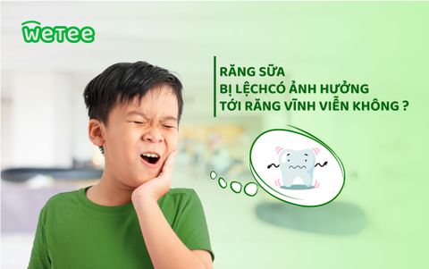 Răng sữa bị lệch có ảnh hưởng tới răng vĩnh viễn không?