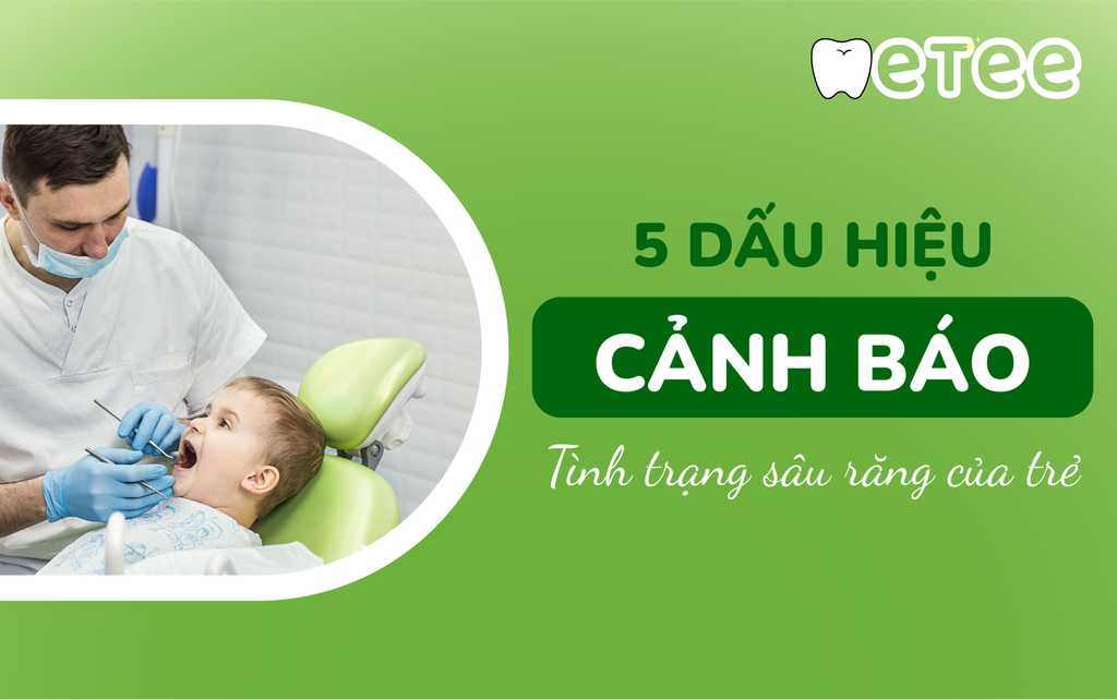 5 dấu hiệu cảnh báo tình trạng sâu răng của trẻ