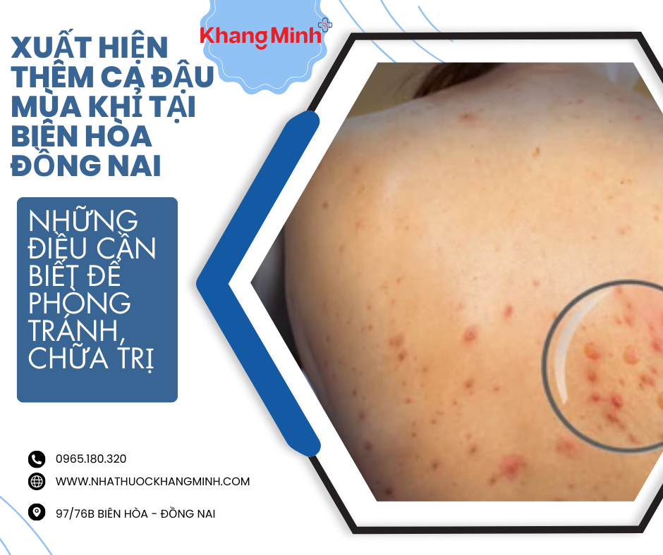 Xuất Hiện Thêm Ca Đậu Mùa Khỉ Tại Biên Hòa Đồng Nai - Cách Phòng Tránh Và Các Dấu Hiệu