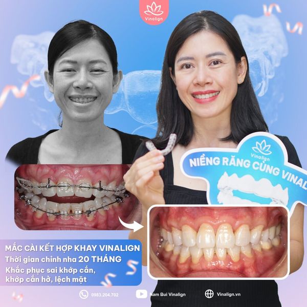 Hình ảnh bài viết