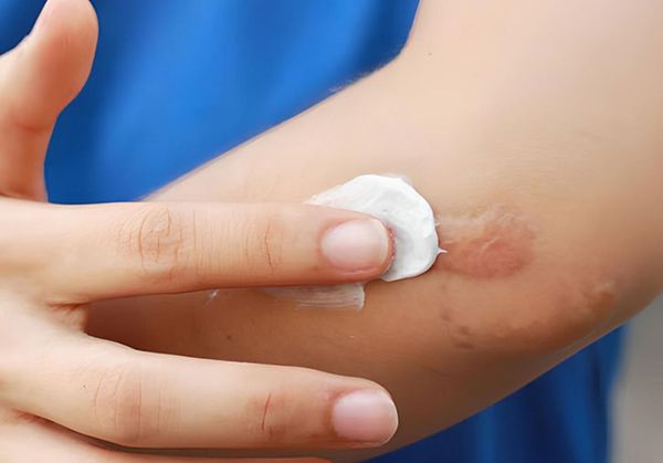 Thuốc trị sẹo là gì?