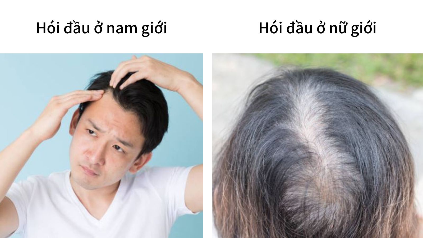 Hói đầu ở nam và nữ khác nhau như thế nào?