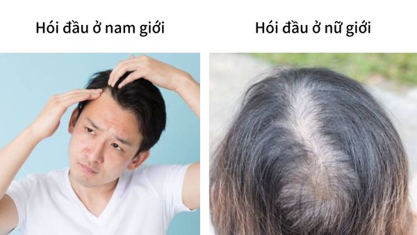 Hói đầu ở nam và nữ khác nhau như thế nào?